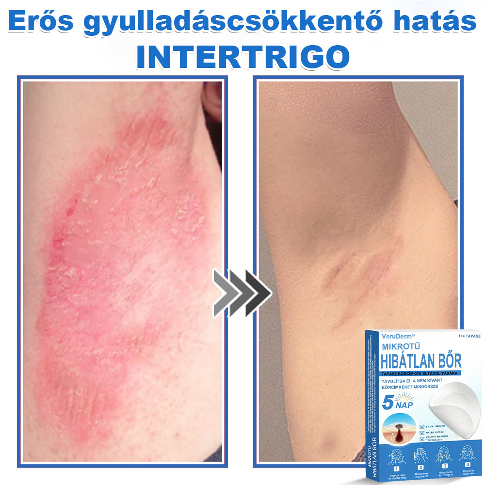 VeruDerm® 2 az 1-ben mikrotűs és hidrokolloid tapasz | Kiemelkedő anyajegyek, pattanások, lapos szemölcsök és bőrkinövések ápolására ✅ | Segít javítani a ráncok, hegek és bőrhibák megjelenését ✨ | Láthatatlan pattanástapasz arcra és testre | 144 db 🍃