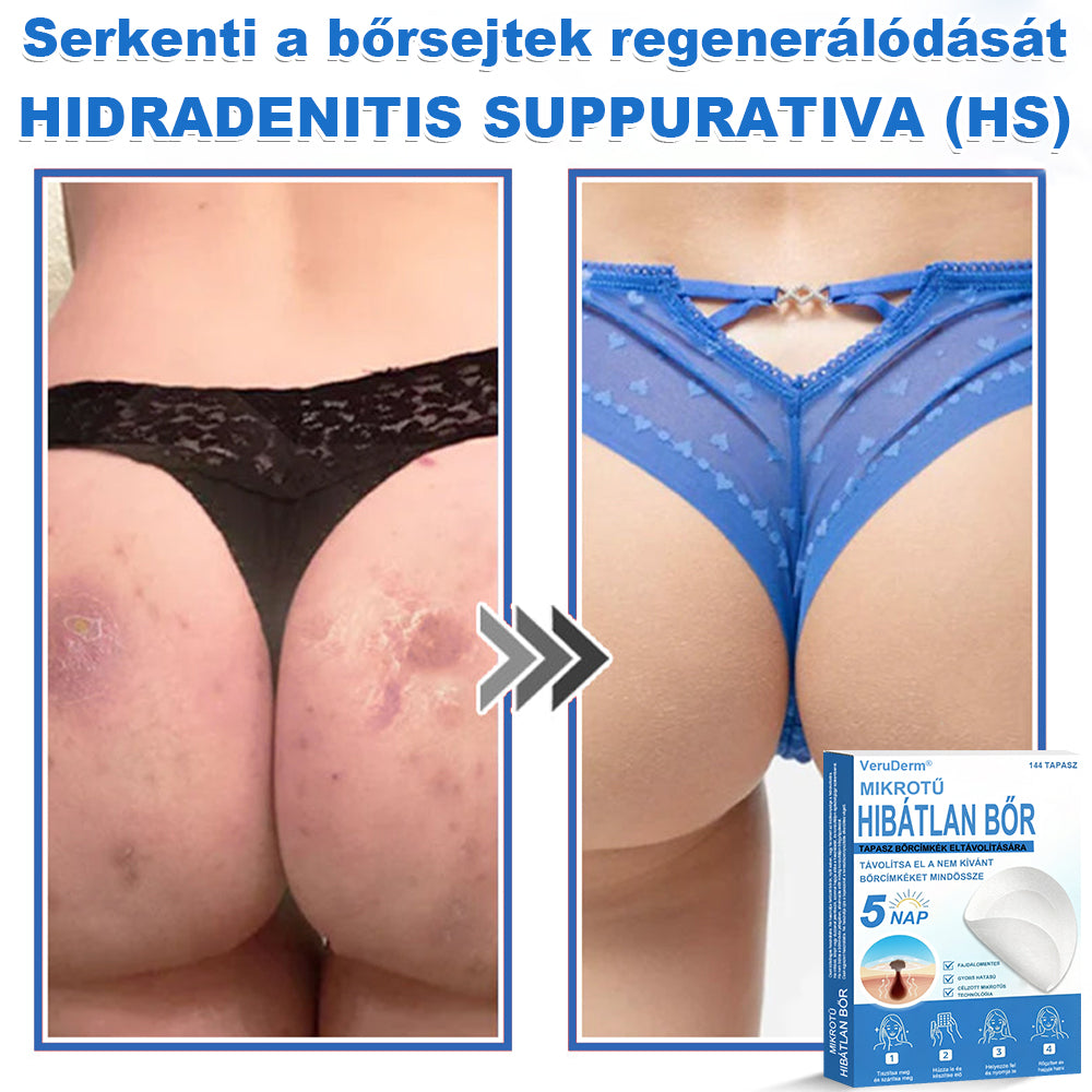 VeruDerm® 2 az 1-ben mikrotűs és hidrokolloid tapasz | Kiemelkedő anyajegyek, pattanások, lapos szemölcsök és bőrkinövések ápolására ✅ | Segít javítani a ráncok, hegek és bőrhibák megjelenését ✨ | Láthatatlan pattanástapasz arcra és testre | 144 db 🍃