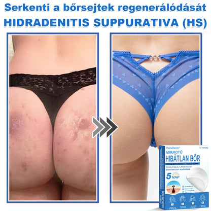 VeruDerm® 2 az 1-ben mikrotűs és hidrokolloid tapasz | Kiemelkedő anyajegyek, pattanások, lapos szemölcsök és bőrkinövések ápolására ✅ | Segít javítani a ráncok, hegek és bőrhibák megjelenését ✨ | Láthatatlan pattanástapasz arcra és testre | 144 db 🍃