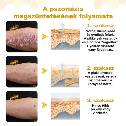 🐝 Auralithe® PsoriaSoothe – Szteroidmentes méhméreges krém viszkető, hámló és érzékeny bőrre 🍎