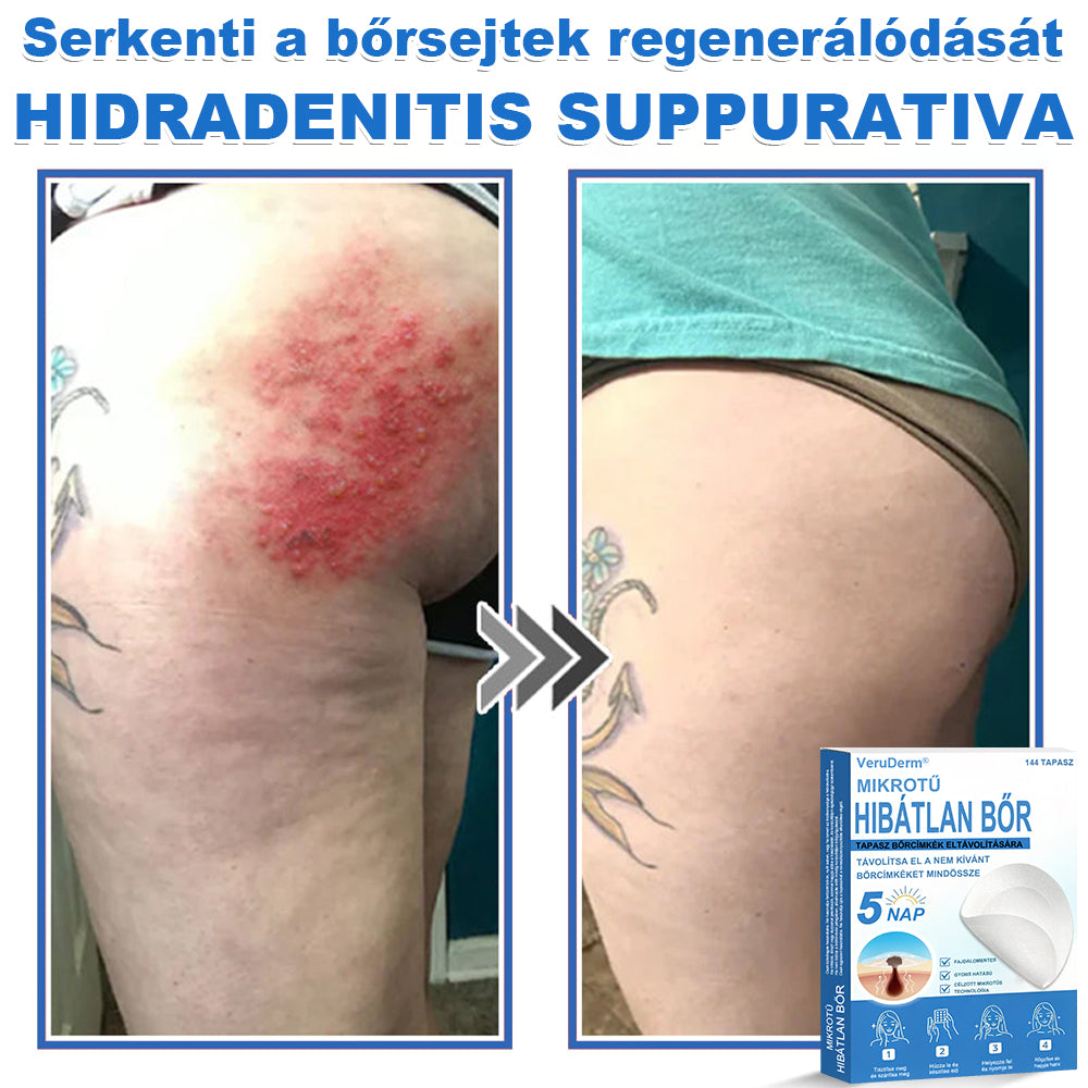 VeruDerm® 2 az 1-ben mikrotűs és hidrokolloid tapasz | Kiemelkedő anyajegyek, pattanások, lapos szemölcsök és bőrkinövések ápolására ✅ | Segít javítani a ráncok, hegek és bőrhibák megjelenését ✨ | Láthatatlan pattanástapasz arcra és testre | 144 db 🍃