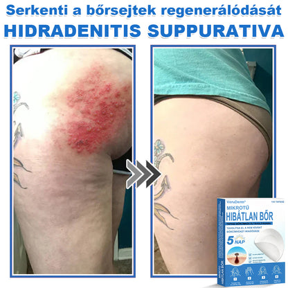 VeruDerm® 2 az 1-ben mikrotűs és hidrokolloid tapasz | Kiemelkedő anyajegyek, pattanások, lapos szemölcsök és bőrkinövések ápolására ✅ | Segít javítani a ráncok, hegek és bőrhibák megjelenését ✨ | Láthatatlan pattanástapasz arcra és testre | 144 db 🍃