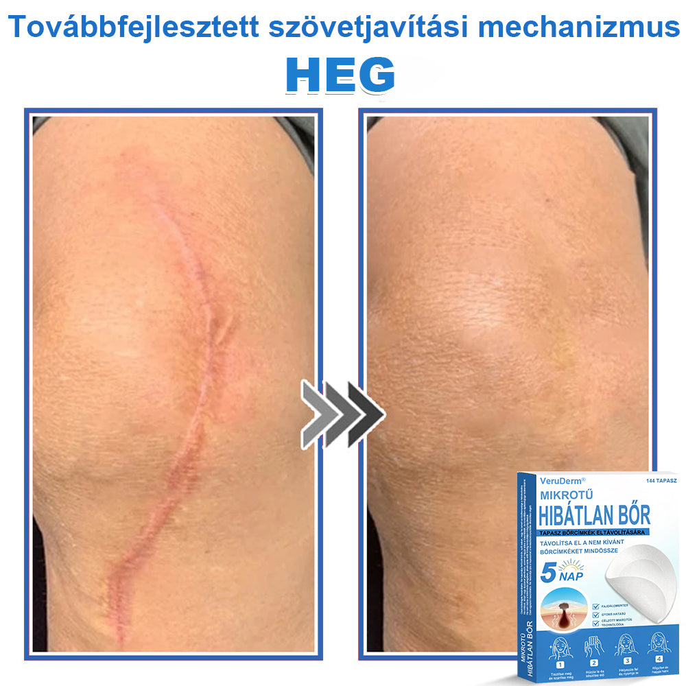 VeruDerm® 2 az 1-ben mikrotűs és hidrokolloid tapasz | Kiemelkedő anyajegyek, pattanások, lapos szemölcsök és bőrkinövések ápolására ✅ | Segít javítani a ráncok, hegek és bőrhibák megjelenését ✨ | Láthatatlan pattanástapasz arcra és testre | 144 db 🍃