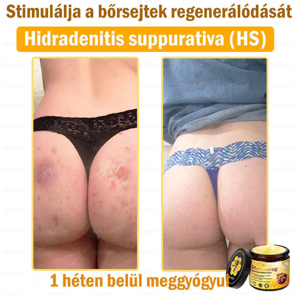 🔥🐝 VLSVLS® Méhméreg Bőrhelyreállító Krém | Teljeskörű Bőrregenerálás | Ekcéma, Pikkelysömör, Rosacea, Szemölcsök & Hegek Ellen | Gyors Hatás 5 Nap Alatt | 100% Természetes & Nem Invazív Megoldás 💯✨