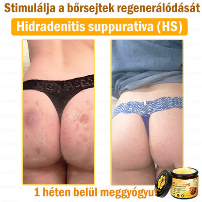 🔥🐝 VLSVLS® Méhméreg Bőrhelyreállító Krém | Teljeskörű Bőrregenerálás | Ekcéma, Pikkelysömör, Rosacea, Szemölcsök & Hegek Ellen | Gyors Hatás 5 Nap Alatt | 100% Természetes & Nem Invazív Megoldás 💯✨