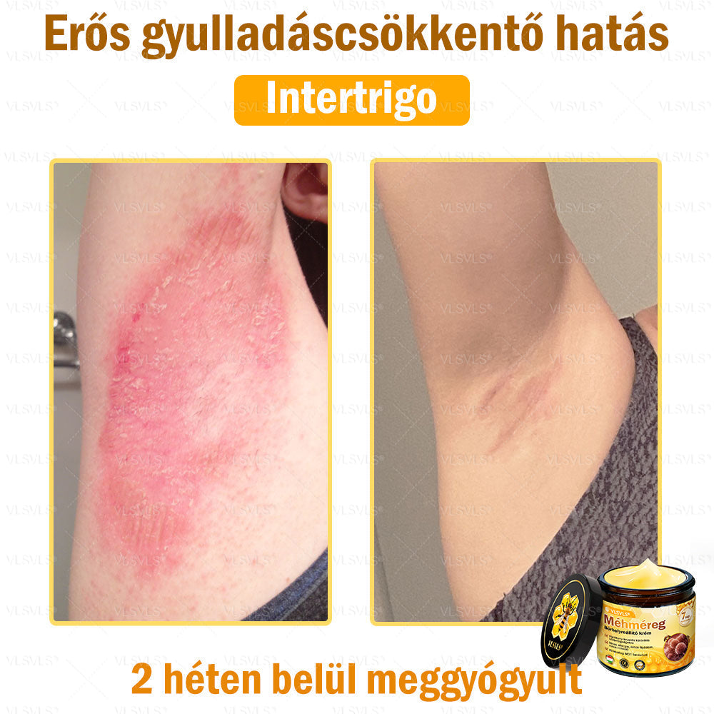 🔥🐝 VLSVLS® Méhméreg Bőrhelyreállító Krém | Teljeskörű Bőrregenerálás | Ekcéma, Pikkelysömör, Rosacea, Szemölcsök & Hegek Ellen | Gyors Hatás 5 Nap Alatt | 100% Természetes & Nem Invazív Megoldás 💯✨
