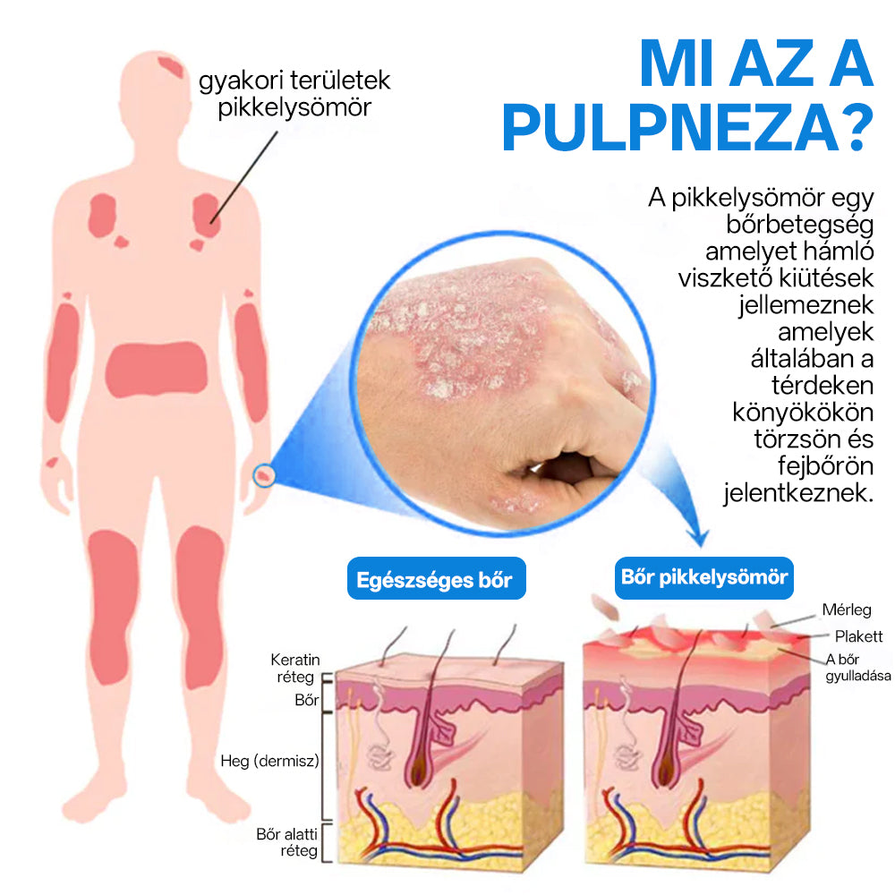 Zvevo® Magnézium Gyógynövényes Pikkelysömör Spray – Természetes bőrregeneráló megoldás viszketés, bőrpír és ekcéma ellen | 💧 Gyors felszívódás | 🚫 Szteroidmentes formula | ✨ Érzékeny és intim bőrre is