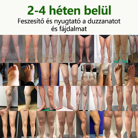 🌿 Mondjon búcsút a duzzadt, fájó lábaknak – Twinsun™ FluidEase Professional Lábkeringési Krém hozza a valódi megkönnyebbülést! ✨🦵