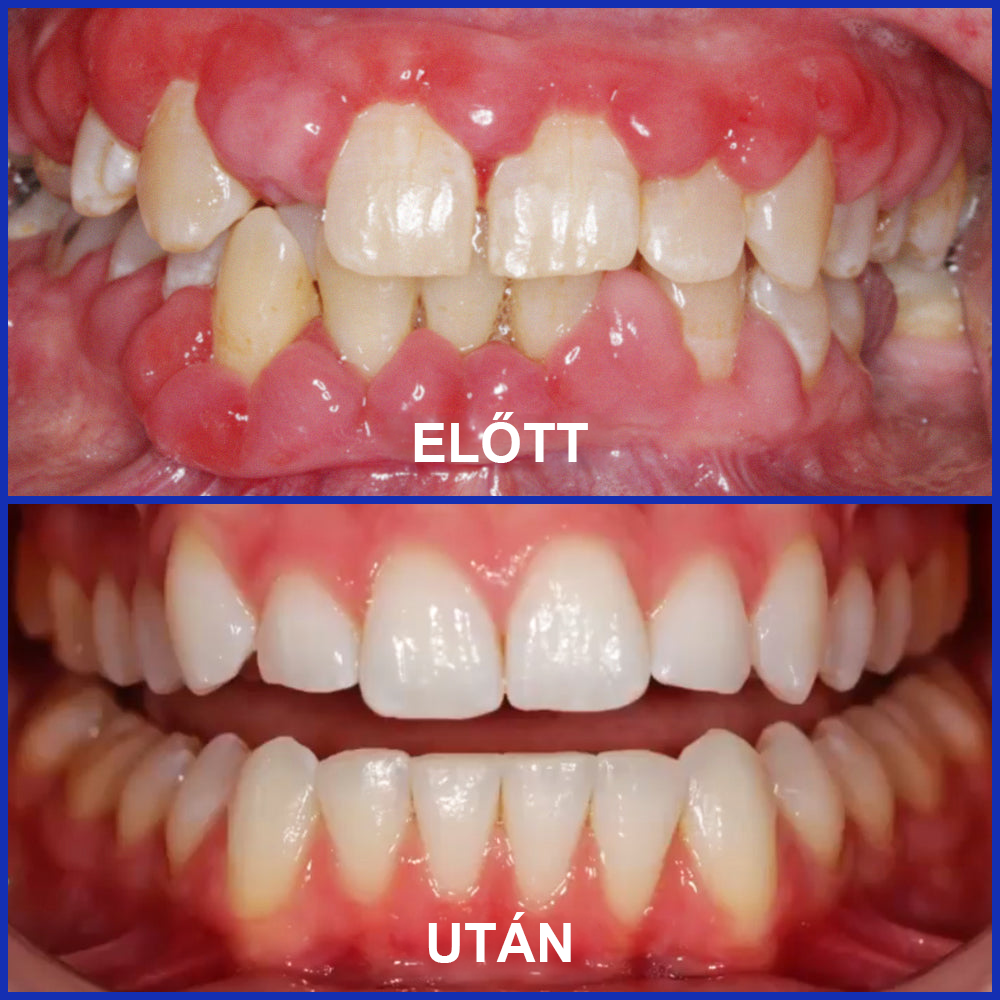 🌟 Rolimey® VioCore Propolisz fogkrém 🦷 Fogfájás enyhítése 3 nap alatt · 7 napos ínyregeneráció · Parodontális betegségek megelőzése · Méhméreg és természetes ásványi anyagok tökéletes kombinációja 🌟