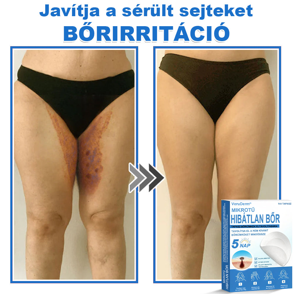 VeruDerm® 2 az 1-ben mikrotűs és hidrokolloid tapasz | Kiemelkedő anyajegyek, pattanások, lapos szemölcsök és bőrkinövések ápolására ✅ | Segít javítani a ráncok, hegek és bőrhibák megjelenését ✨ | Láthatatlan pattanástapasz arcra és testre | 144 db 🍃