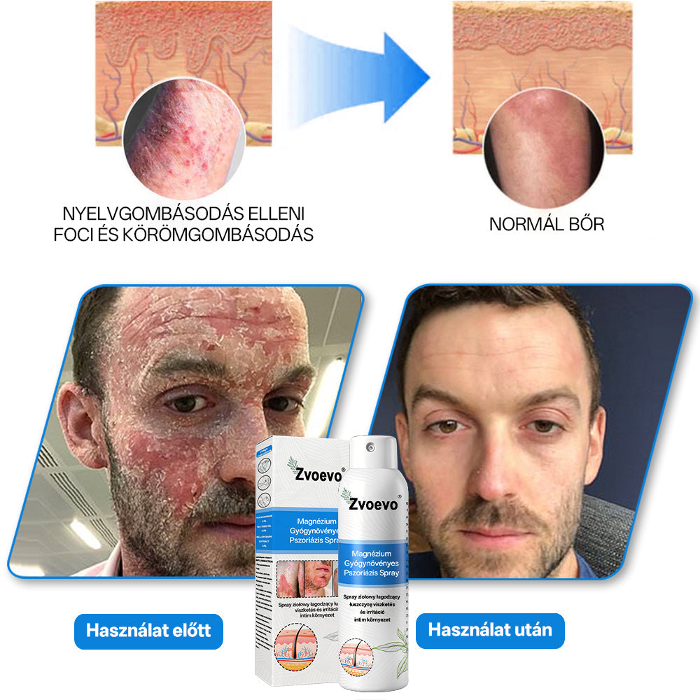 Zvevo® Magnézium Gyógynövényes Pikkelysömör Spray – Természetes bőrregeneráló megoldás viszketés, bőrpír és ekcéma ellen | 💧 Gyors felszívódás | 🚫 Szteroidmentes formula | ✨ Érzékeny és intim bőrre is