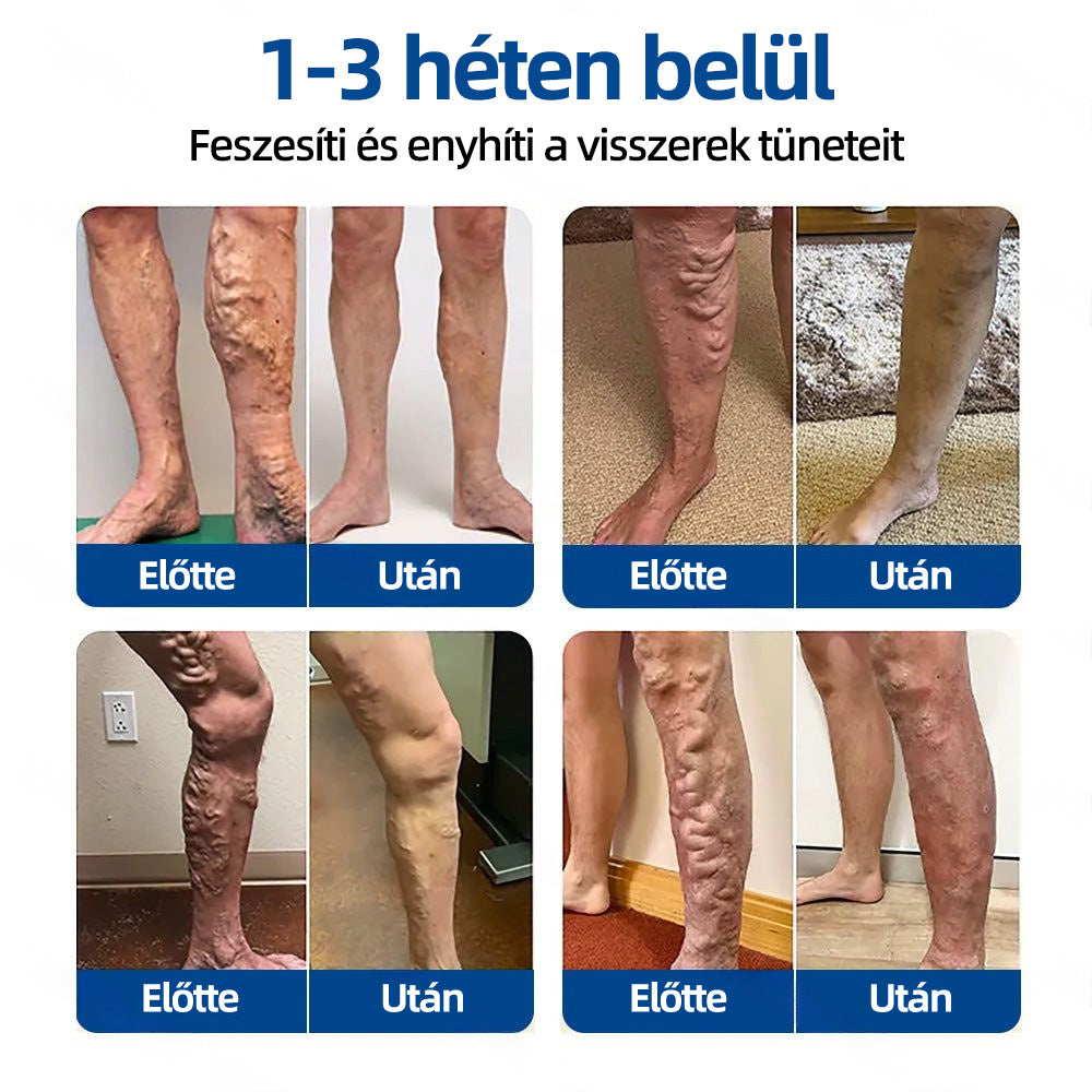 🇭🇺 𝐇𝐞𝐚𝐥𝐫𝐢𝐳𝐞® VeinTarget mikrotűs tapasz 🌿 | alpesi növényi vénás támogatás 🦵 | transzdermális mikrotű technológia ⚡ | krónikus vénás elégtelenségre | otthoni használat | gyors felszívódás | 96% klinikai siker 💪