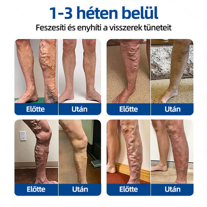 🇭🇺 𝐇𝐞𝐚𝐥𝐫𝐢𝐳𝐞® VeinTarget mikrotűs tapasz 🌿 | alpesi növényi vénás támogatás 🦵 | transzdermális mikrotű technológia ⚡ | krónikus vénás elégtelenségre | otthoni használat | gyors felszívódás | 96% klinikai siker 💪