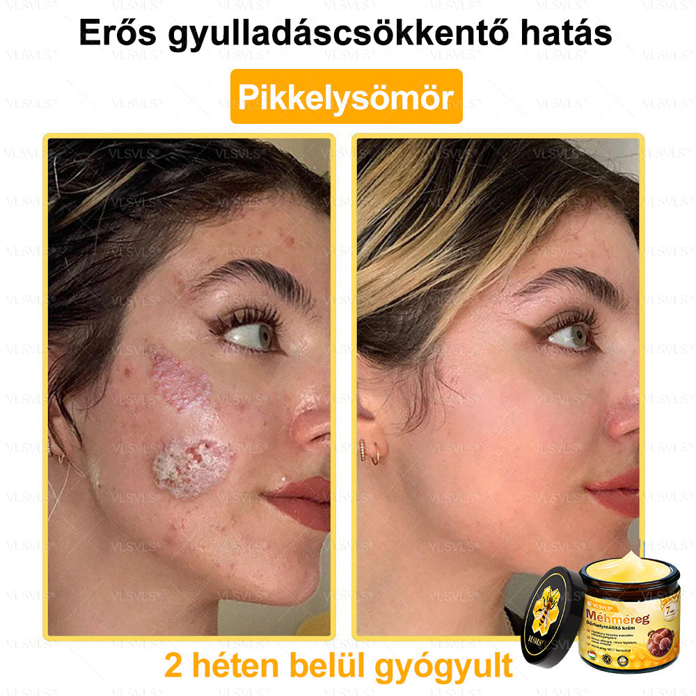 🔥🐝 VLSVLS® Méhméreg Bőrhelyreállító Krém | Teljeskörű Bőrregenerálás | Ekcéma, Pikkelysömör, Rosacea, Szemölcsök & Hegek Ellen | Gyors Hatás 5 Nap Alatt | 100% Természetes & Nem Invazív Megoldás 💯✨