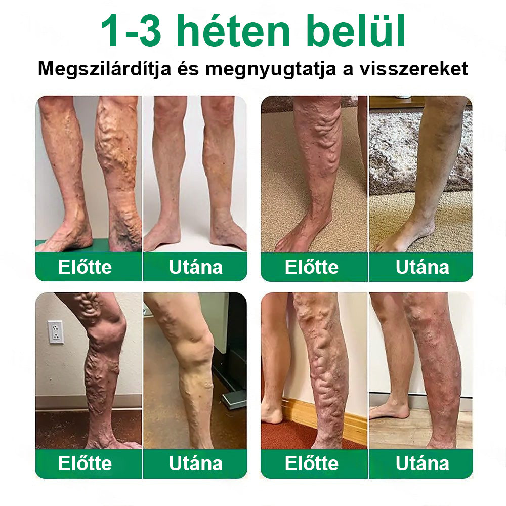 ✨ Twisma® VeinTarget – Fejlett mikro tapasz a visszerekre 🔥 96% klinikailag igazolt hatékonyság ⚡ Látható eredmények már 7–14 nap alatt 🌿 Kíméletes támogatás a könnyebb és felszabadult lábakért  🦵