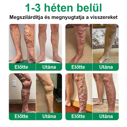 ✨ Twisma® VeinTarget – Fejlett mikro tapasz a visszerekre 🔥 96% klinikailag igazolt hatékonyság ⚡ Látható eredmények már 7–14 nap alatt 🌿 Kíméletes támogatás a könnyebb és felszabadult lábakért  🦵