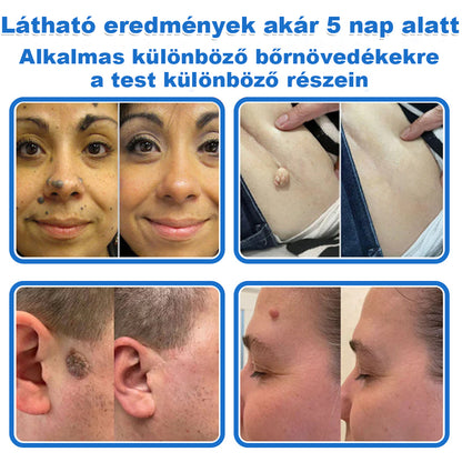 VeruDerm® 2 az 1-ben mikrotűs és hidrokolloid tapasz | Kiemelkedő anyajegyek, pattanások, lapos szemölcsök és bőrkinövések ápolására ✅ | Segít javítani a ráncok, hegek és bőrhibák megjelenését ✨ | Láthatatlan pattanástapasz arcra és testre | 144 db 🍃