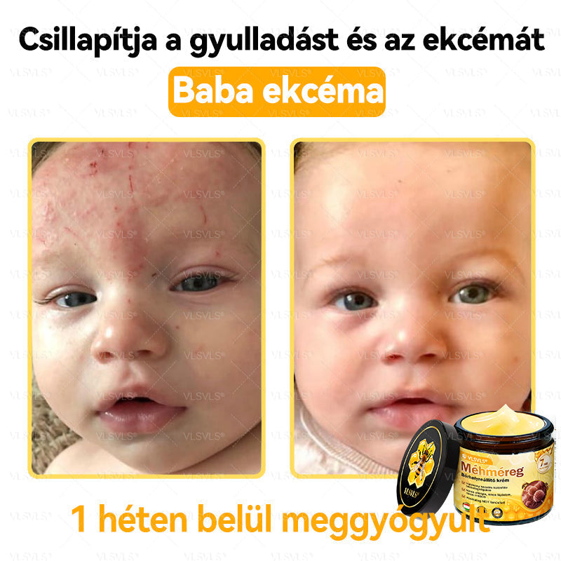 🔥🐝 VLSVLS® Méhméreg Bőrhelyreállító Krém | Teljeskörű Bőrregenerálás | Ekcéma, Pikkelysömör, Rosacea, Szemölcsök & Hegek Ellen | Gyors Hatás 5 Nap Alatt | 100% Természetes & Nem Invazív Megoldás 💯✨
