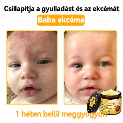 🔥🐝 VLSVLS® Méhméreg Bőrhelyreállító Krém | Teljeskörű Bőrregenerálás | Ekcéma, Pikkelysömör, Rosacea, Szemölcsök & Hegek Ellen | Gyors Hatás 5 Nap Alatt | 100% Természetes & Nem Invazív Megoldás 💯✨