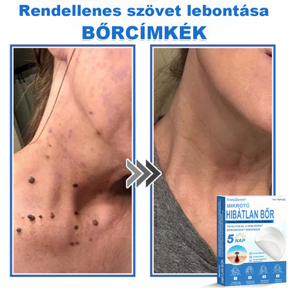 VeruDerm® 2 az 1-ben mikrotűs és hidrokolloid tapasz | Kiemelkedő anyajegyek, pattanások, lapos szemölcsök és bőrkinövések ápolására ✅ | Segít javítani a ráncok, hegek és bőrhibák megjelenését ✨ | Láthatatlan pattanástapasz arcra és testre | 144 db 🍃