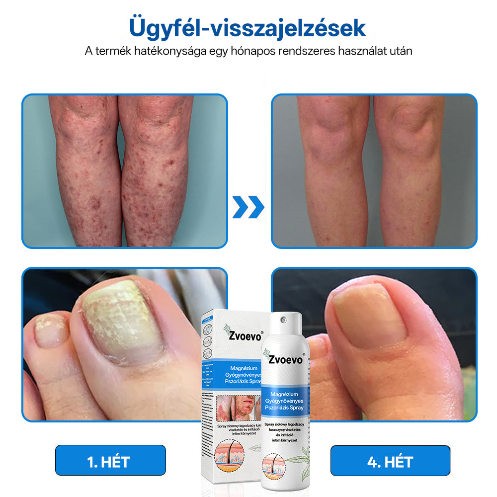 Zvevo® Magnézium Gyógynövényes Pikkelysömör Spray – Természetes bőrregeneráló megoldás viszketés, bőrpír és ekcéma ellen | 💧 Gyors felszívódás | 🚫 Szteroidmentes formula | ✨ Érzékeny és intim bőrre is