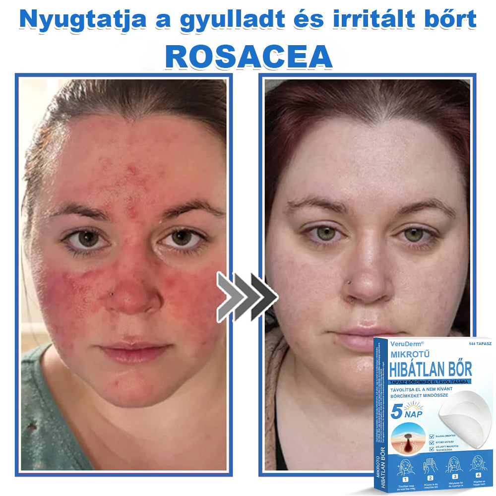 VeruDerm® 2 az 1-ben mikrotűs és hidrokolloid tapasz | Kiemelkedő anyajegyek, pattanások, lapos szemölcsök és bőrkinövések ápolására ✅ | Segít javítani a ráncok, hegek és bőrhibák megjelenését ✨ | Láthatatlan pattanástapasz arcra és testre | 144 db 🍃