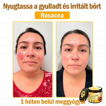 🔥🐝 VLSVLS® Méhméreg Bőrhelyreállító Krém | Teljeskörű Bőrregenerálás | Ekcéma, Pikkelysömör, Rosacea, Szemölcsök & Hegek Ellen | Gyors Hatás 5 Nap Alatt | 100% Természetes & Nem Invazív Megoldás 💯✨