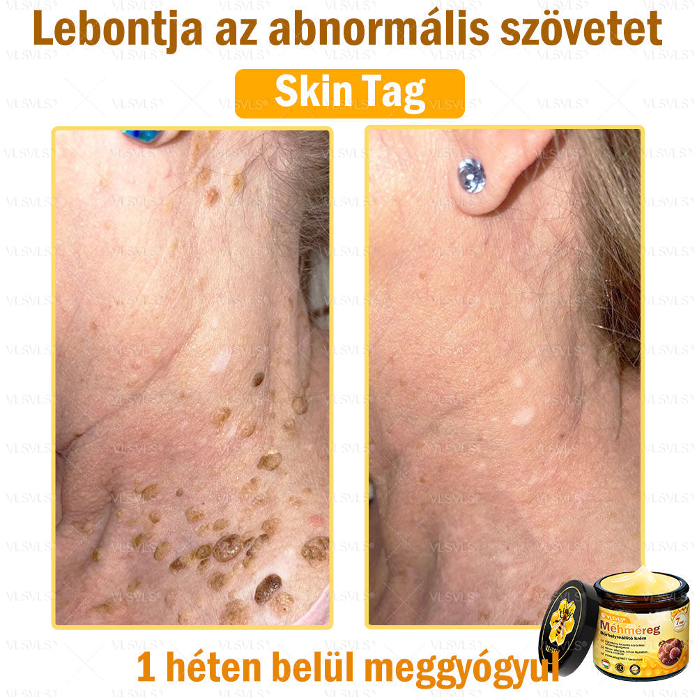 🔥🐝 VLSVLS® Méhméreg Bőrhelyreállító Krém | Teljeskörű Bőrregenerálás | Ekcéma, Pikkelysömör, Rosacea, Szemölcsök & Hegek Ellen | Gyors Hatás 5 Nap Alatt | 100% Természetes & Nem Invazív Megoldás 💯✨