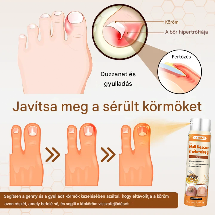 💥 2026 Korlátozott 70% KEDVEZMÉNY ️⏳ Ceoerty® NailRescue Kolirin méhméreg körömgomba spray 💥 Minden körömproblémát orvosolhatsz 2 héten belül🌿🌿