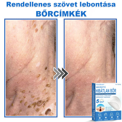 VeruDerm® 2 az 1-ben mikrotűs és hidrokolloid tapasz | Kiemelkedő anyajegyek, pattanások, lapos szemölcsök és bőrkinövések ápolására ✅ | Segít javítani a ráncok, hegek és bőrhibák megjelenését ✨ | Láthatatlan pattanástapasz arcra és testre | 144 db 🍃