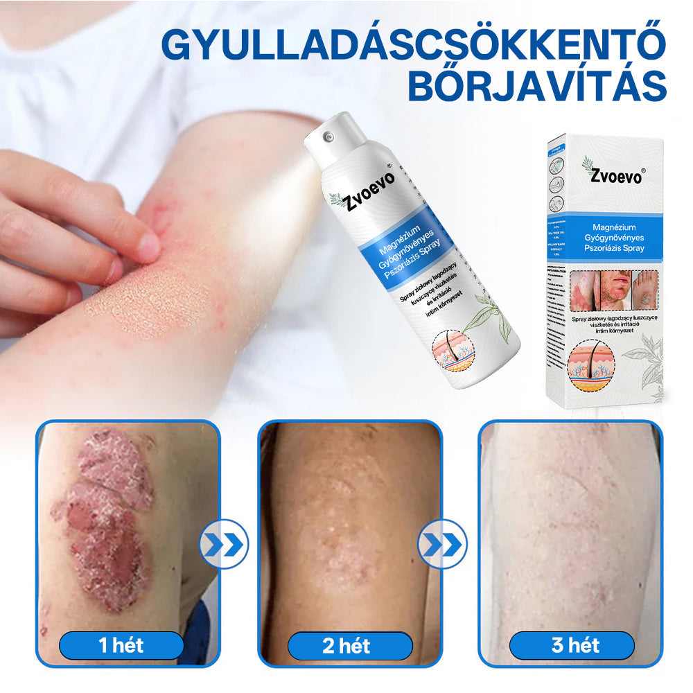 Zvevo® Magnézium Gyógynövényes Pikkelysömör Spray – Természetes bőrregeneráló megoldás viszketés, bőrpír és ekcéma ellen | 💧 Gyors felszívódás | 🚫 Szteroidmentes formula | ✨ Érzékeny és intim bőrre is