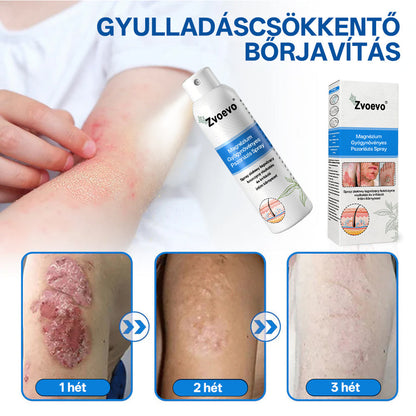 Zvevo® Magnézium Gyógynövényes Pikkelysömör Spray – Természetes bőrregeneráló megoldás viszketés, bőrpír és ekcéma ellen | 💧 Gyors felszívódás | 🚫 Szteroidmentes formula | ✨ Érzékeny és intim bőrre is