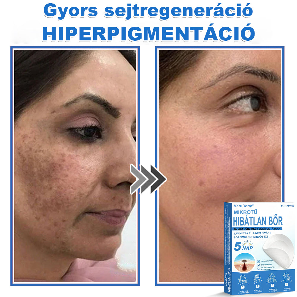 VeruDerm® 2 az 1-ben mikrotűs és hidrokolloid tapasz | Kiemelkedő anyajegyek, pattanások, lapos szemölcsök és bőrkinövések ápolására ✅ | Segít javítani a ráncok, hegek és bőrhibák megjelenését ✨ | Láthatatlan pattanástapasz arcra és testre | 144 db 🍃