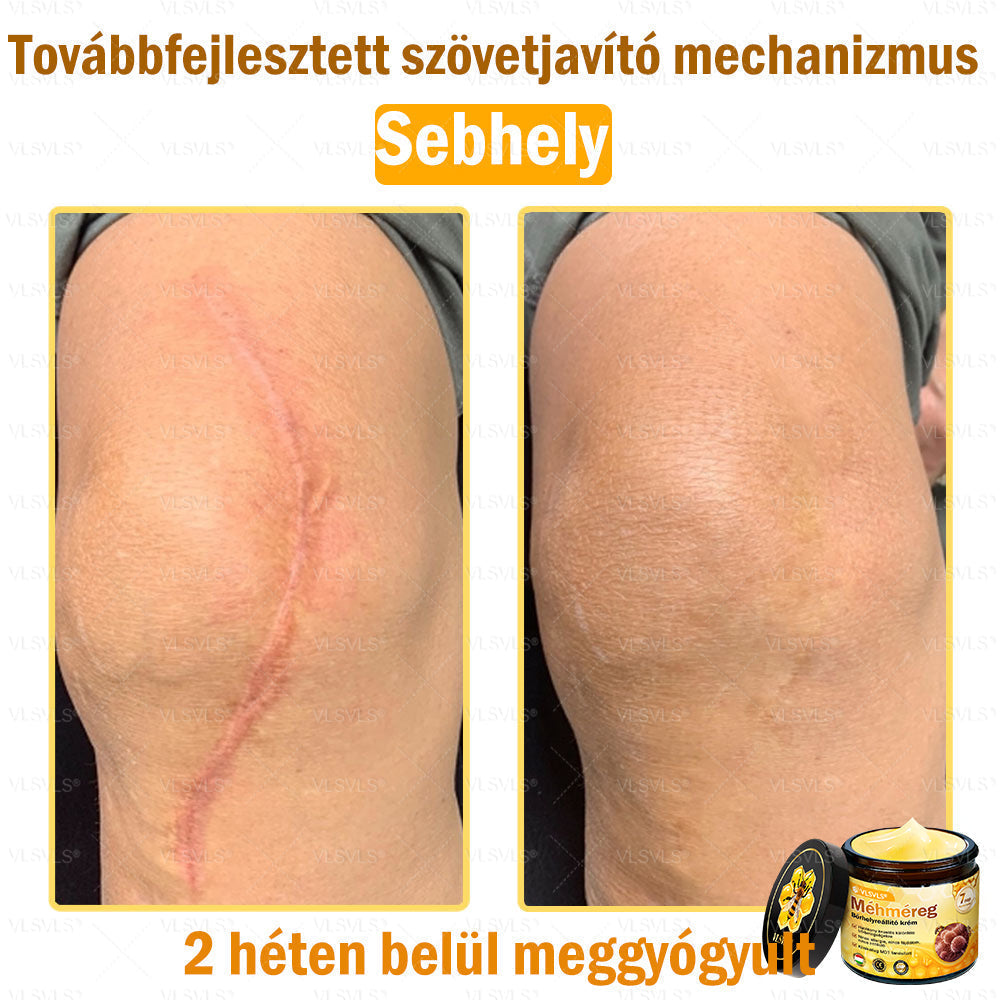 🔥🐝 VLSVLS® Méhméreg Bőrhelyreállító Krém | Teljeskörű Bőrregenerálás | Ekcéma, Pikkelysömör, Rosacea, Szemölcsök & Hegek Ellen | Gyors Hatás 5 Nap Alatt | 100% Természetes & Nem Invazív Megoldás 💯✨