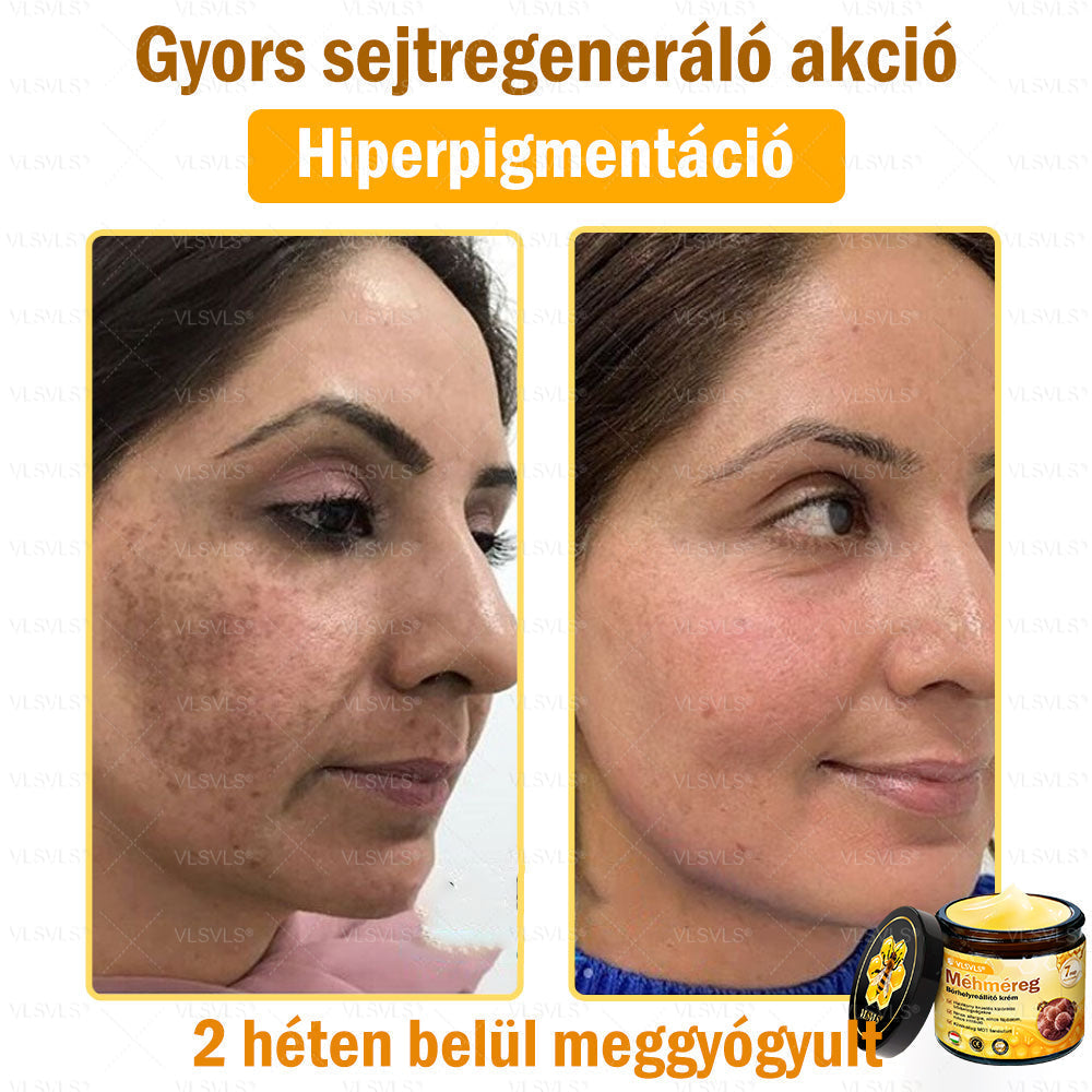 🔥🐝 VLSVLS® Méhméreg Bőrhelyreállító Krém | Teljeskörű Bőrregenerálás | Ekcéma, Pikkelysömör, Rosacea, Szemölcsök & Hegek Ellen | Gyors Hatás 5 Nap Alatt | 100% Természetes & Nem Invazív Megoldás 💯✨